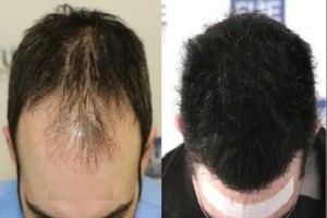 1 روزه و قسطی مو بکارید!👌🏼😍 مطلقا بدون درد با تراکم فوق العاده بالا