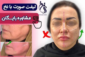 معجزه لیفت با نخ در درمان افتادگی صورت با مشاوره رایگان