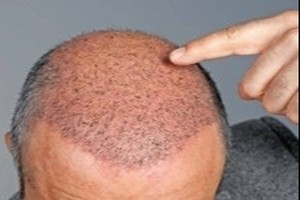 1 روزه و قسطی با تراکم بالا مو بکار! (بدون درد یا خونریزی)