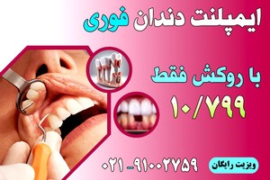 بهترین قیمت ایمپلنت با روکش دیجیتالی و فوری