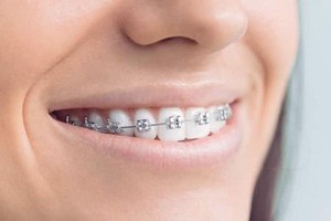 ارتو سریع 3 الی 6 ماه، مناسب همه سنین، اقساط