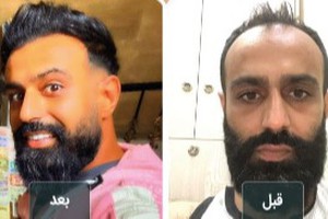 کاشت مو طبیعی با تخفیف 3 میلیونی و پرداختی اقساطی! (برای مدت محدود)