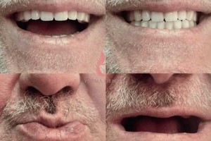 خداحافظی با دندان لق! دندان مصنوعی سبک با چسبندگی بالا | پرداخت قسطی