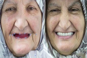 دندان مصنوعی درجه یک با شرایط اقساط