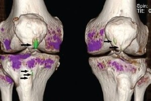درمان درد زانو بدون عمل جراحی و در منزل! 🌟